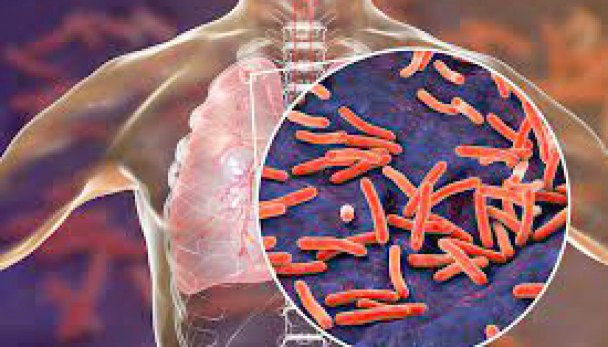 Saúde alerta a população sobre a tuberculose